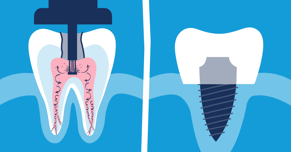 alternatives to root canals