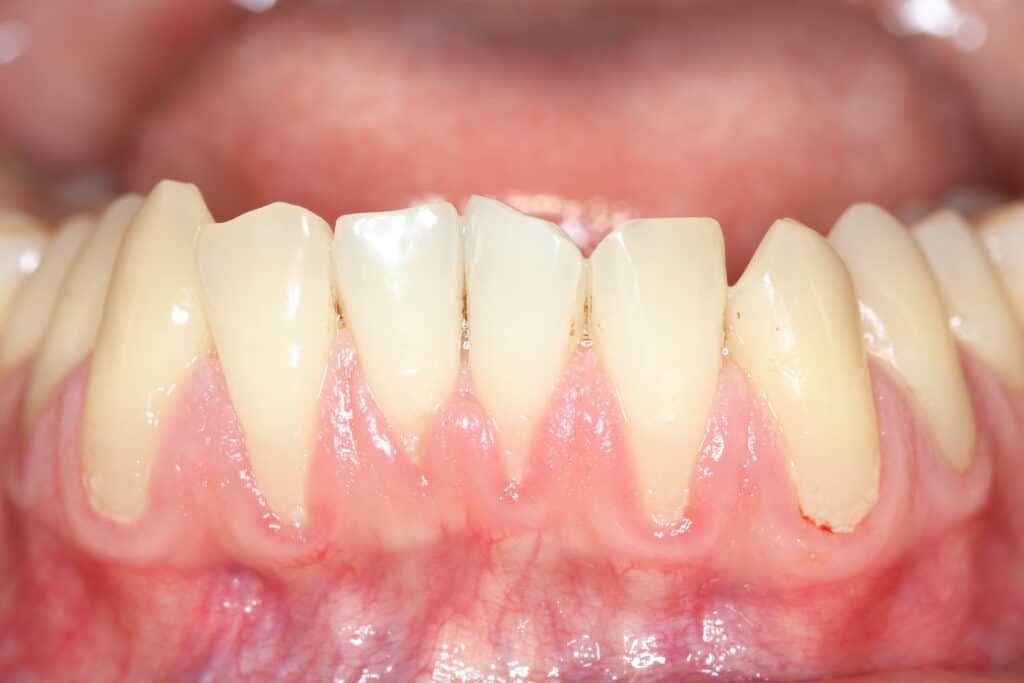 Can Gum Recession Surgery Improve Oral Health?