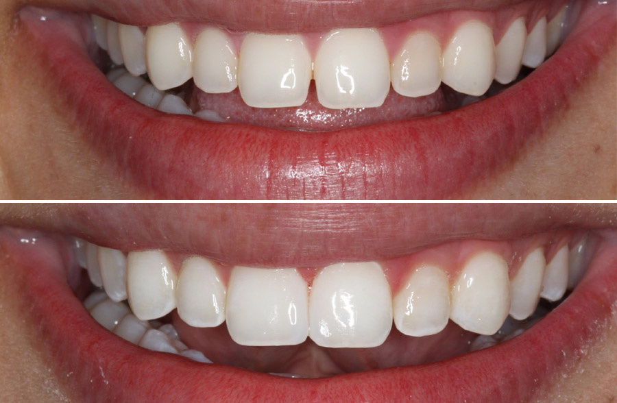 Can Bonding Teeth Before And After Fix Chipped Or Cracked Teeth?