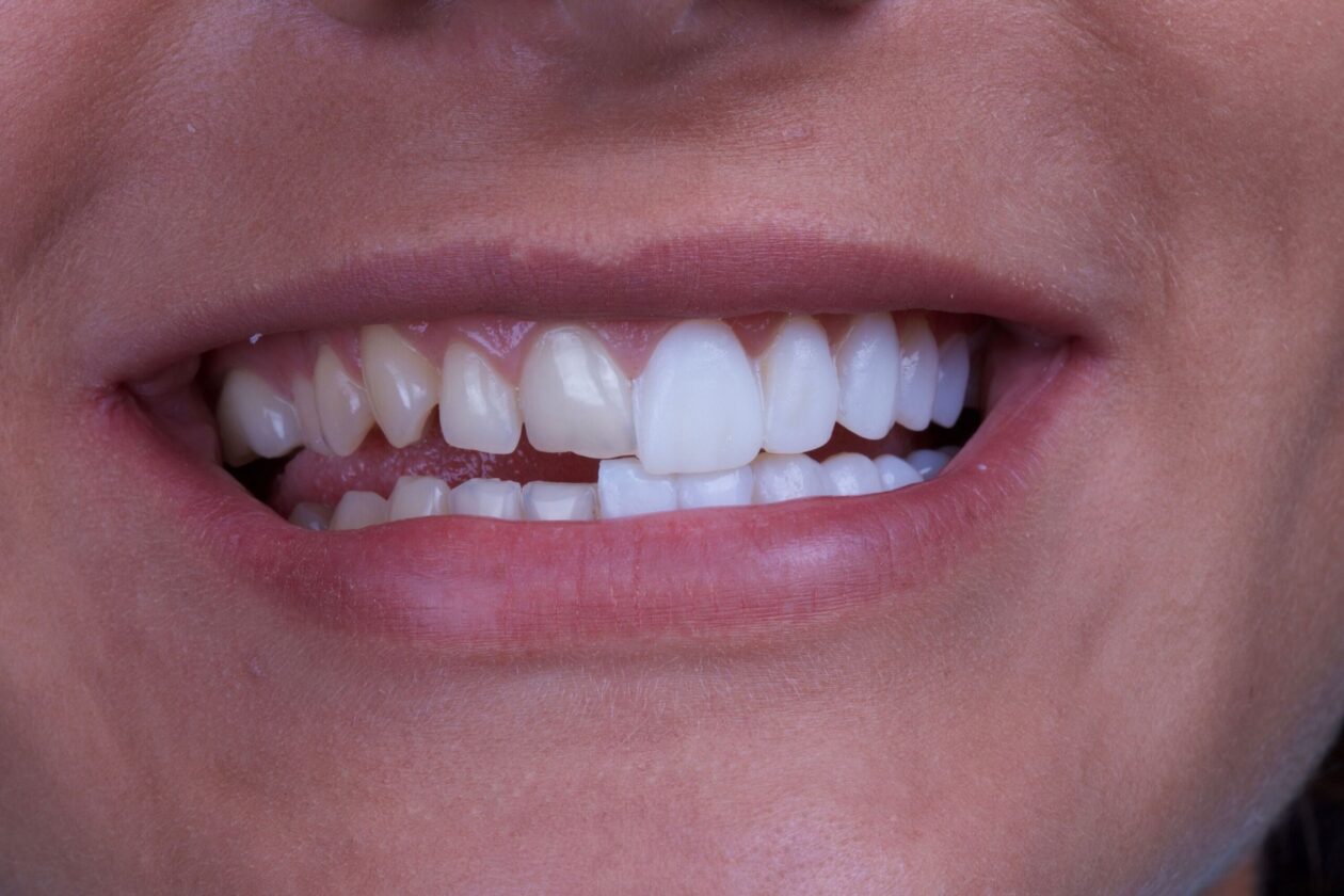 How Much Do Dental Veneers Cost And What Factors Affect The Price?