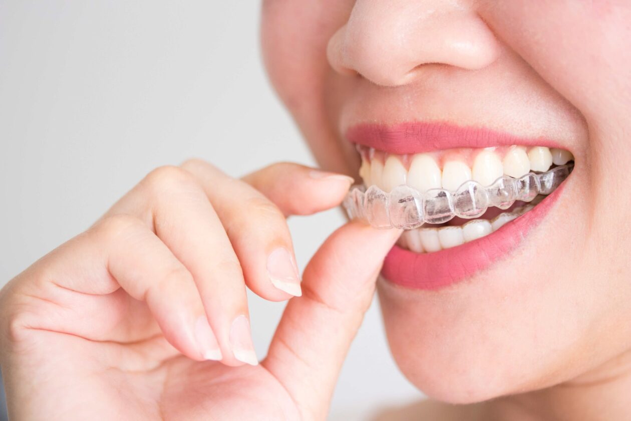 Get A Perfect Smile With Invisalign: Find A Provider Nearby